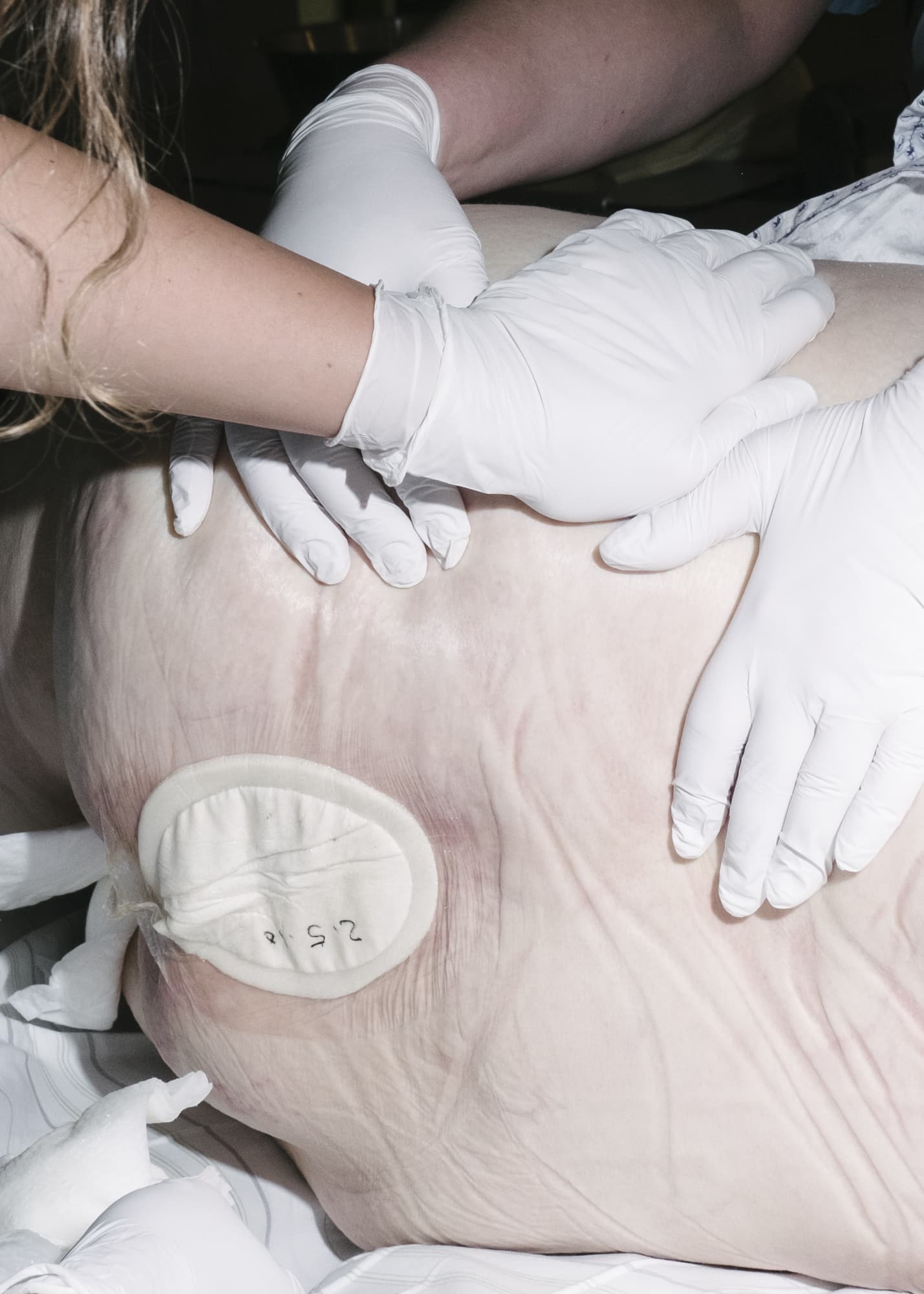 Nicht muede werden — Hand detail of two nurses examining the back of a patient with bedsores