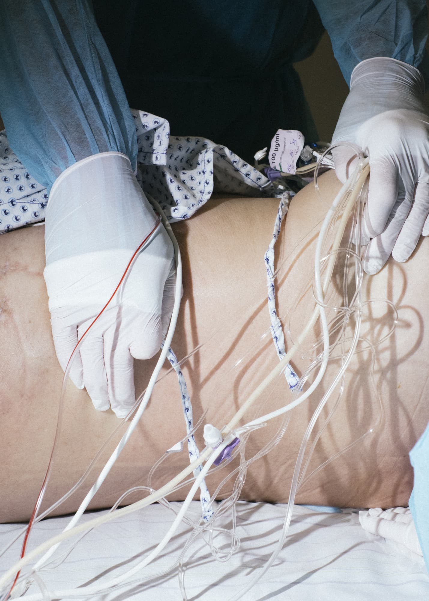 Nicht muede werden — hand detail of a nurse holding cables and pipes for perfusors